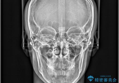 デコボコも深いかみ合わせも…“全部気になる”を一気に解決の治療後