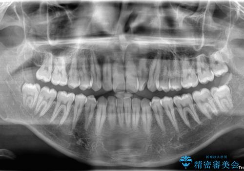 マウスピース矯正と迷った結果…管理のしやすさで選んだクリアブラケット矯正の症例の治療前