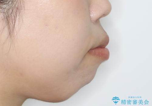 出っ歯が気になる　抜歯+ワイヤー矯正治療の治療前