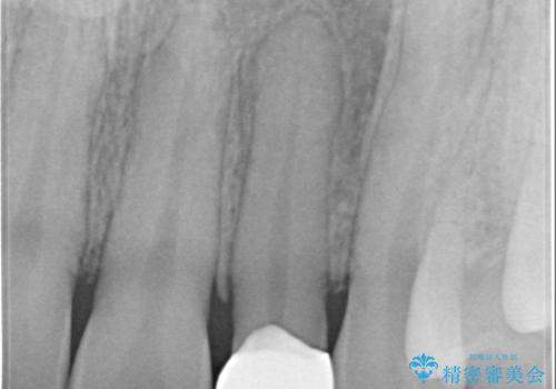 矯正後、矮小歯をオールセラミッククラウンで審美修復の治療後