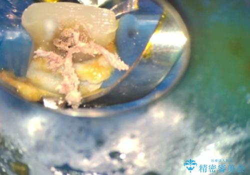 転んで折れた前歯セラミック治療で審美改善の治療前