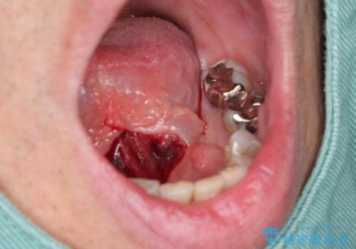 『舌小帯形成術』 ベロの動きを良くして滑舌を改善したいの治療中