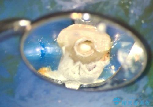 転んで折れた前歯セラミック治療で審美改善の治療前