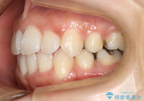 出っ歯が気になる　抜歯+ワイヤー矯正治療の治療後