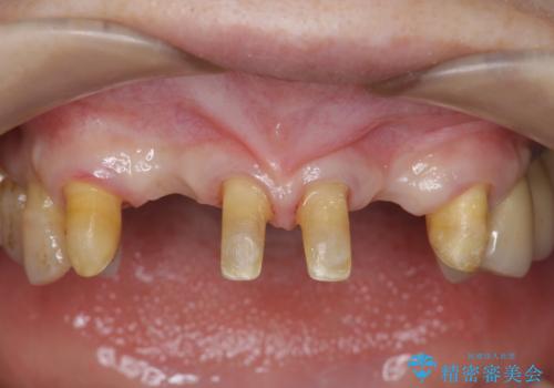 [ 全て歯を抜かなければいけないと言われた] 矯正治療を含む包括的歯周病治療の治療中