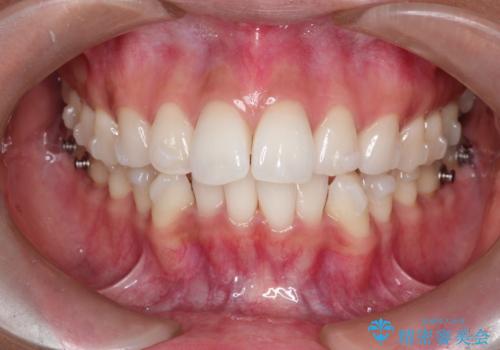 前歯のがたつきをマウスピース矯正で改善。IPRと遠心移動による非抜歯インビザライン治療の治療中