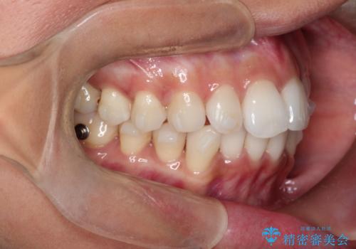 前歯のがたつきをマウスピース矯正で改善。IPRと遠心移動による非抜歯インビザライン治療の治療中