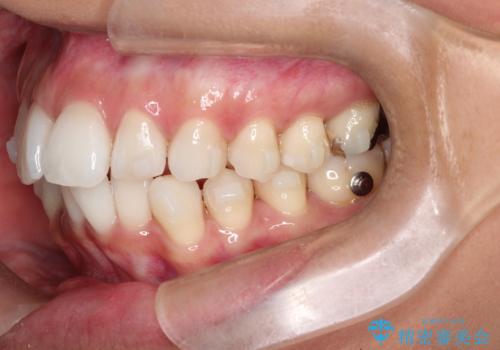 前歯のがたつきをマウスピース矯正で改善。IPRと遠心移動による非抜歯インビザライン治療の治療中