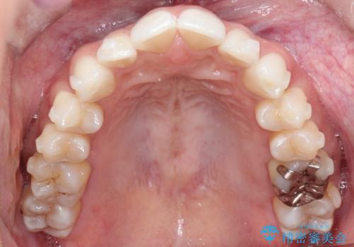 前歯のがたつきをマウスピース矯正で改善。IPRと遠心移動による非抜歯インビザライン治療の治療中
