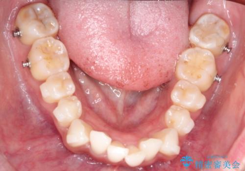 前歯のがたつきをマウスピース矯正で改善。IPRと遠心移動による非抜歯インビザライン治療の治療中
