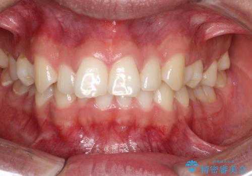 デコボコも深いかみ合わせも…“全部気になる”を一気に解決の治療前