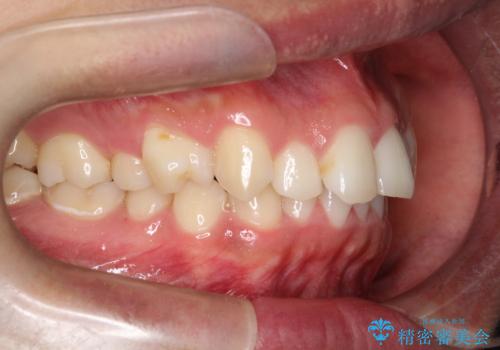 デコボコも深いかみ合わせも…“全部気になる”を一気に解決の治療前