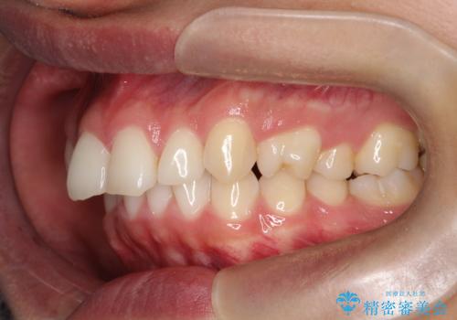 デコボコも深いかみ合わせも…“全部気になる”を一気に解決の治療前