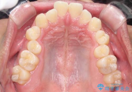 デコボコも深いかみ合わせも…“全部気になる”を一気に解決の治療前