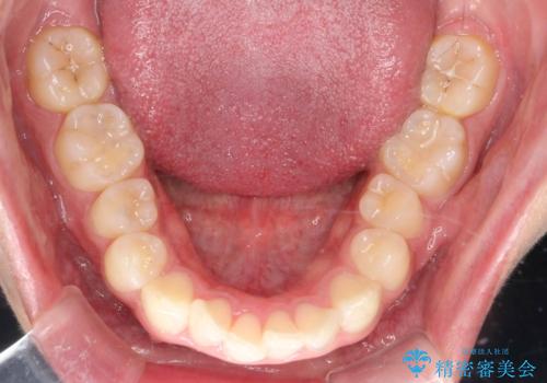 デコボコも深いかみ合わせも…“全部気になる”を一気に解決の治療前