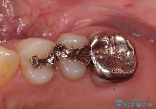 銀歯を自然な白さに。左上小臼歯2本のセラミックインレー修復の症例 治療前