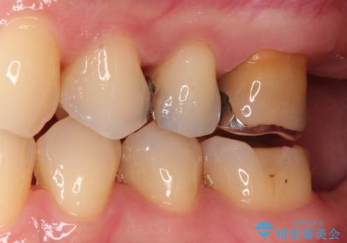 銀歯を自然な白さに。左上小臼歯2本のセラミックインレー修復の治療前