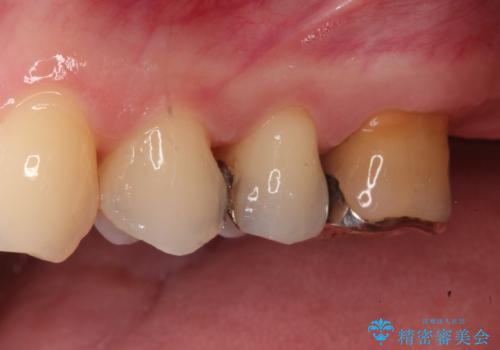 銀歯を自然な白さに。左上小臼歯2本のセラミックインレー修復の治療前