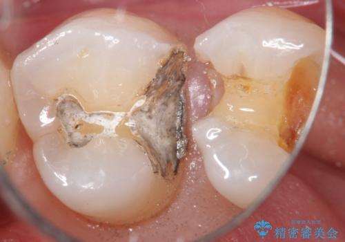 銀歯を自然な白さに。左上小臼歯2本のセラミックインレー修復