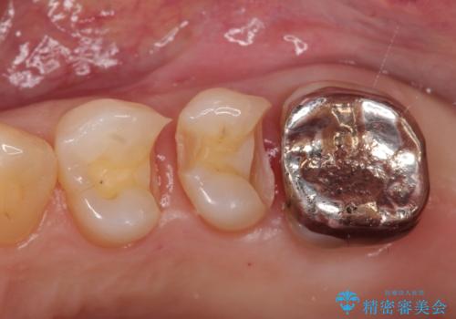 銀歯を自然な白さに。左上小臼歯2本のセラミックインレー修復の治療中