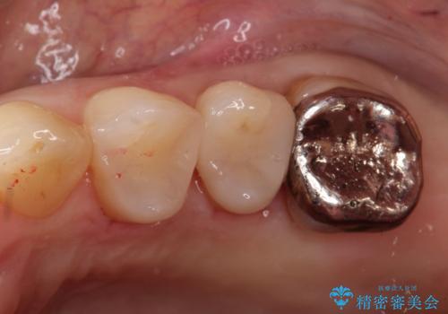 銀歯を自然な白さに。左上小臼歯2本のセラミックインレー修復の症例 治療後