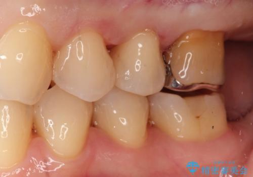 銀歯を自然な白さに。左上小臼歯2本のセラミックインレー修復の治療後