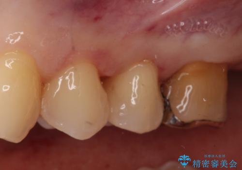 銀歯を自然な白さに。左上小臼歯2本のセラミックインレー修復の治療後