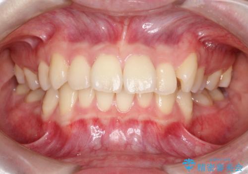 前歯の突出と下顎の偏位を改善。審美ワイヤーで整えるバランスの良い歯並びの症例 治療前