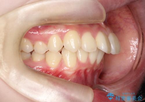 前歯の突出と下顎の偏位を改善。審美ワイヤーで整えるバランスの良い歯並びの治療前