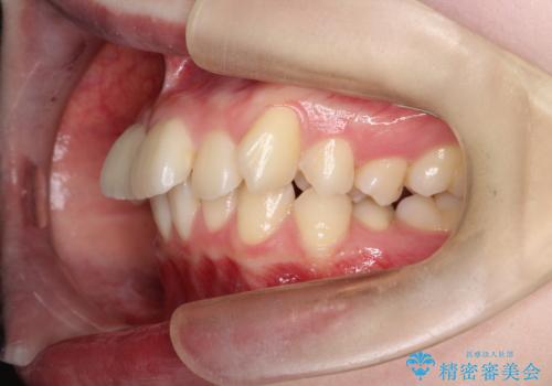 前歯の突出と下顎の偏位を改善。審美ワイヤーで整えるバランスの良い歯並びの治療前