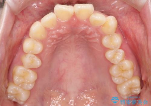 前歯の突出と下顎の偏位を改善。審美ワイヤーで整えるバランスの良い歯並びの治療前
