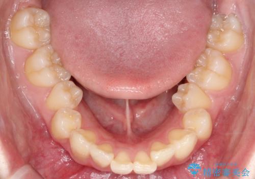 前歯の突出と下顎の偏位を改善。審美ワイヤーで整えるバランスの良い歯並びの治療前