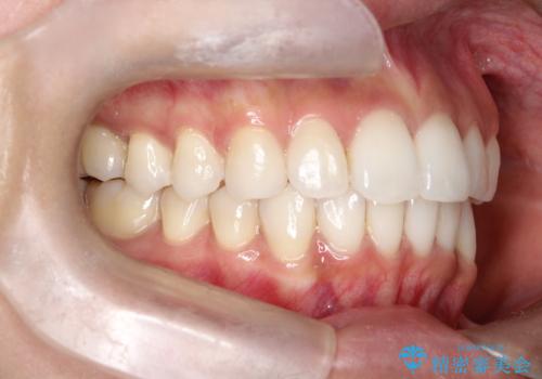 前歯のがたつきをマウスピース矯正で改善。IPRと遠心移動による非抜歯インビザライン治療の治療後