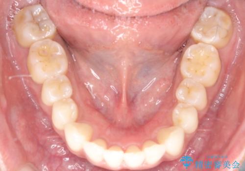 前歯のがたつきをマウスピース矯正で改善。IPRと遠心移動による非抜歯インビザライン治療の治療後