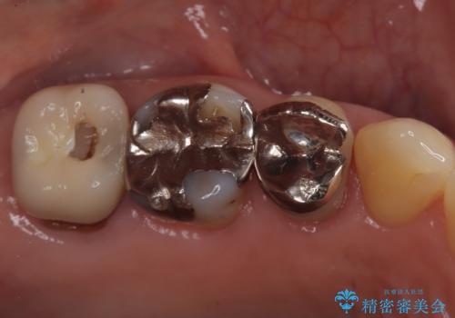 銀歯からセラミックへ。右上奥歯の精密根管治療と審美修復の症例 治療前