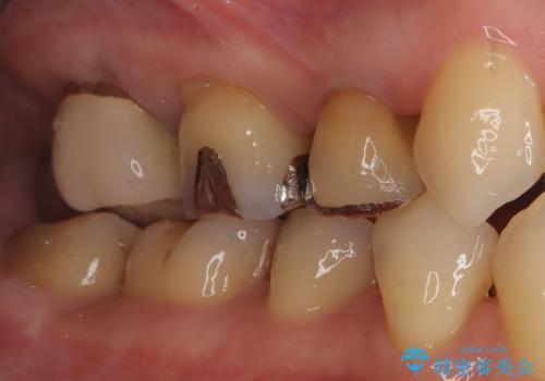 銀歯からセラミックへ。右上奥歯の精密根管治療と審美修復の治療前