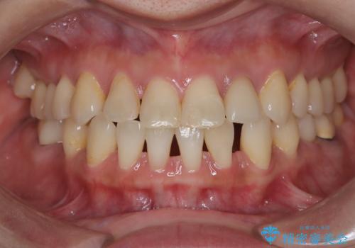 歯の隙間と欠損を同時に解決。インビザラインとインプラントを組み合わせた包括的治療の症例 治療前