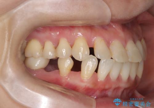 歯の隙間と欠損を同時に解決。インビザラインとインプラントを組み合わせた包括的治療の治療前