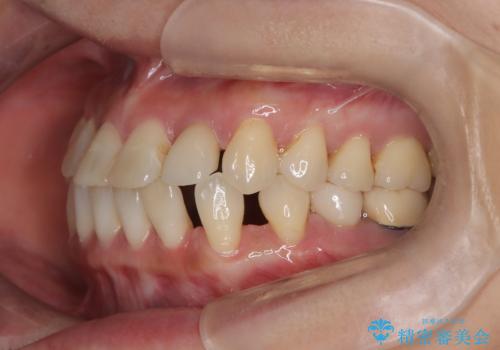 歯の隙間と欠損を同時に解決。インビザラインとインプラントを組み合わせた包括的治療の治療前