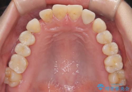 歯の隙間と欠損を同時に解決。インビザラインとインプラントを組み合わせた包括的治療の治療前