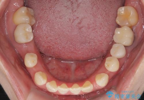 歯の隙間と欠損を同時に解決。インビザラインとインプラントを組み合わせた包括的治療の治療前