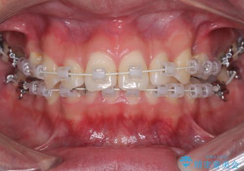 デコボコも深いかみ合わせも…“全部気になる”を一気に解決の治療中