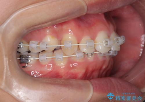デコボコも深いかみ合わせも…“全部気になる”を一気に解決の治療中