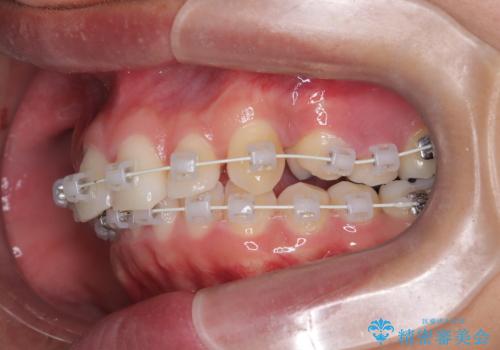 デコボコも深いかみ合わせも…“全部気になる”を一気に解決の治療中