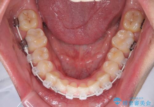 デコボコも深いかみ合わせも…“全部気になる”を一気に解決の治療中