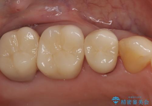 銀歯からセラミックへ。右上奥歯の精密根管治療と審美修復