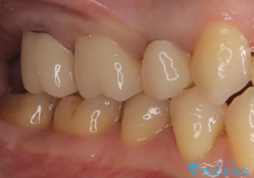銀歯からセラミックへ。右上奥歯の精密根管治療と審美修復の治療後