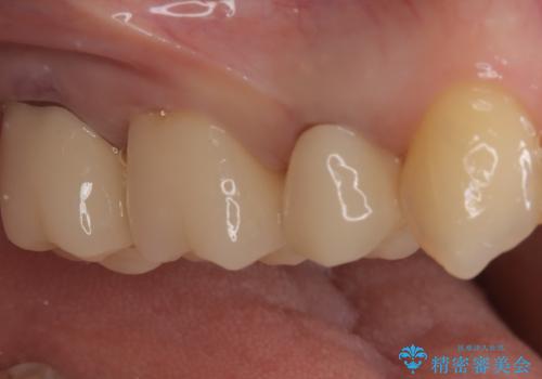 銀歯からセラミックへ。右上奥歯の精密根管治療と審美修復の治療後
