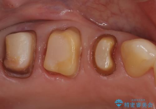 銀歯からセラミックへ。右上奥歯の精密根管治療と審美修復の治療中