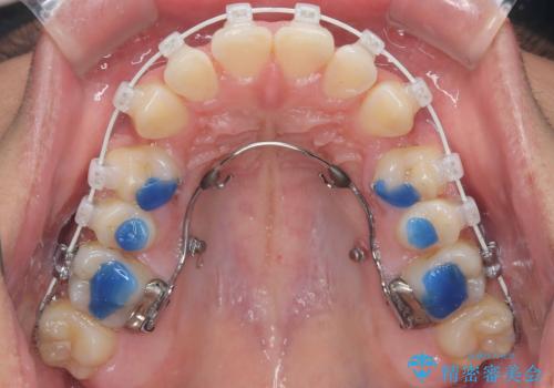 デコボコも深いかみ合わせも…“全部気になる”を一気に解決の治療中